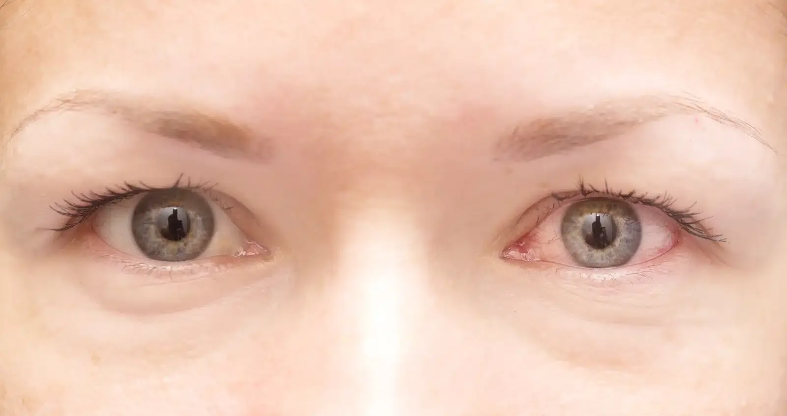 What Can I Do For Dilated Pupils?